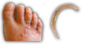 A human foot infected with hook worm